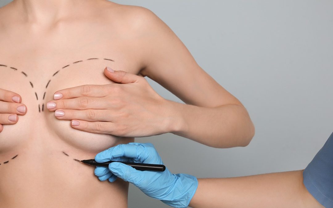 Conseils pour réussir une augmentation mammaire à Lyon